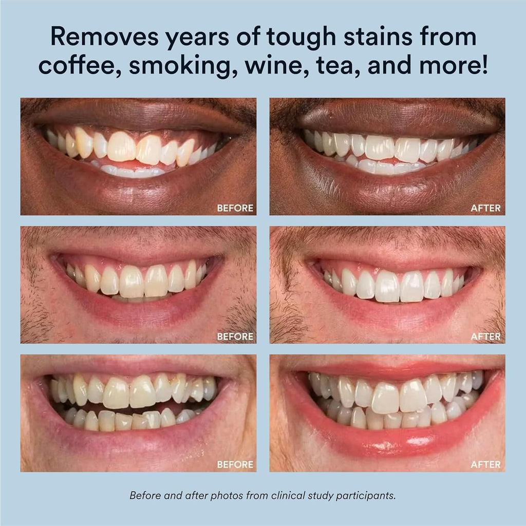Transform Your Smile with Our Advanced Teeth Whitening Kit – LED Accelerator Light & 35% Carbamide Peroxide Gel for Up to 10 Shades Whiter in Just 7 Days!