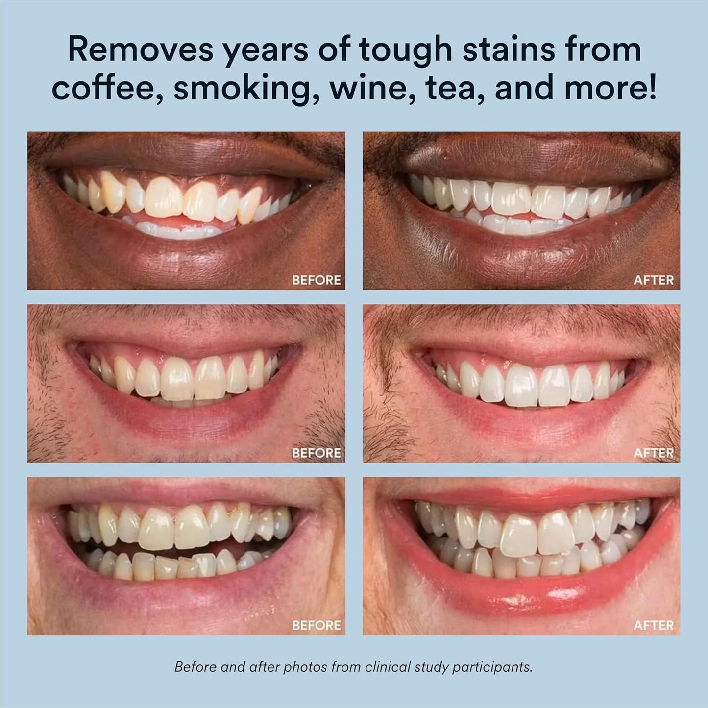 Transform Your Smile with Our Advanced Teeth Whitening Kit – LED Accelerator Light & 35% Carbamide Peroxide Gel for Up to 10 Shades Whiter in Just 7 Days!